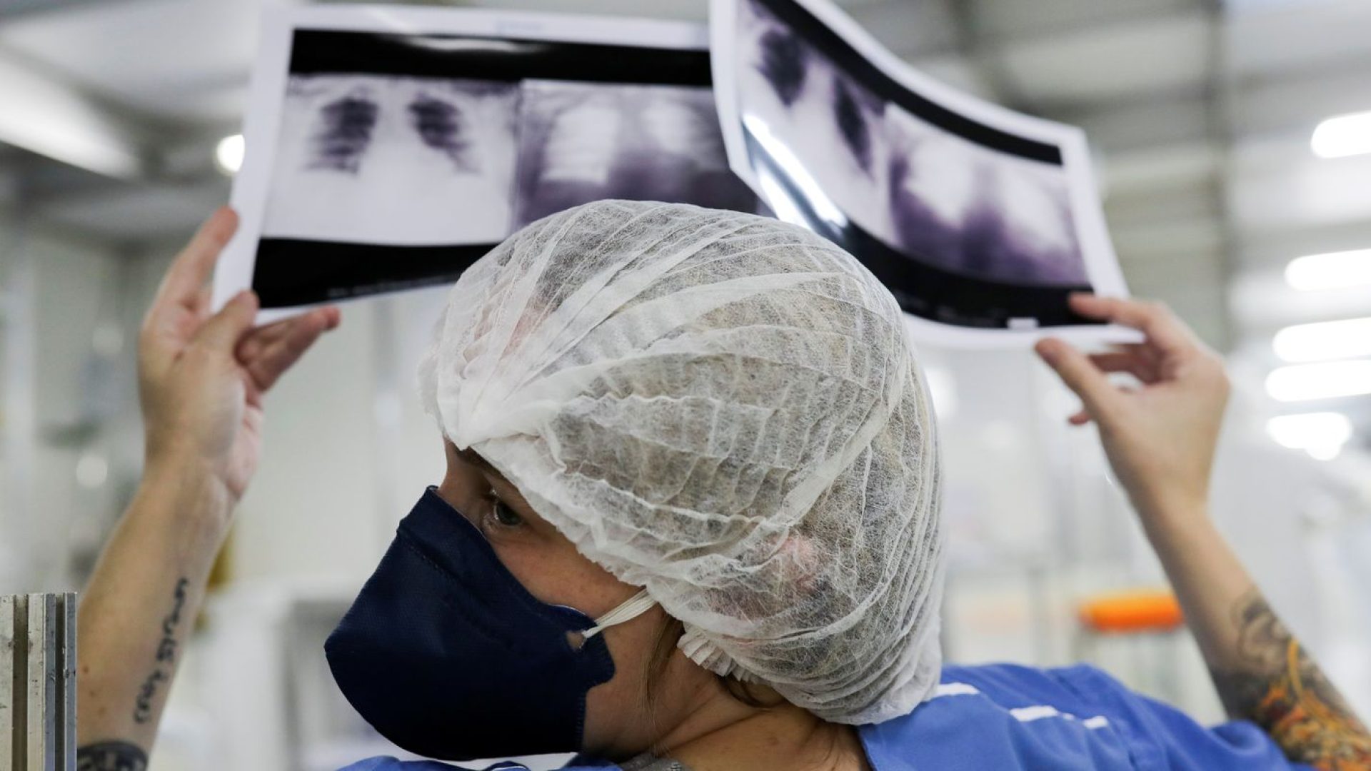 Diagnóstico tardio dá poucas chances de cura do câncer de pulmão